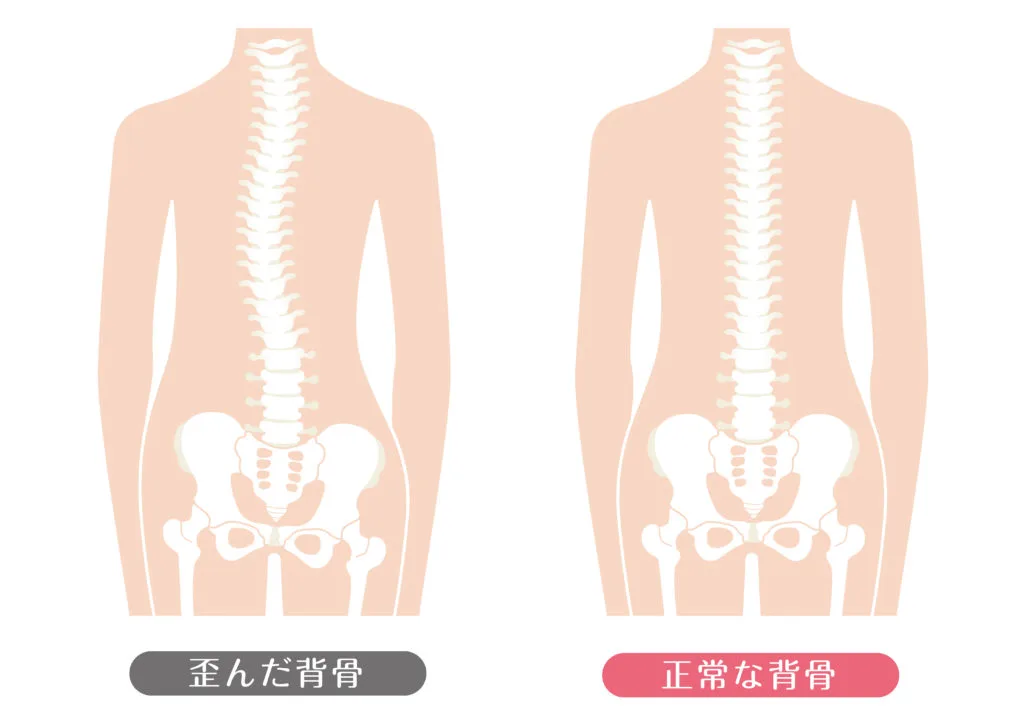 歪んだ背骨と正常な背骨