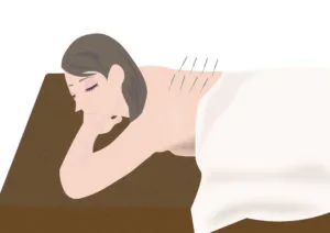 鍼の施術を受ける女性