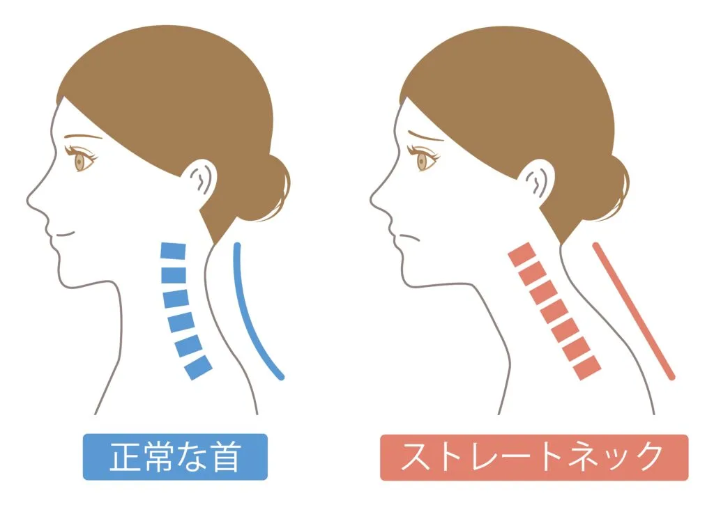 正常な首とストレートネックの比較