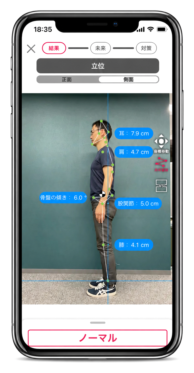 側面姿勢分析 結果画面 — 猫背・ストレートネック・骨盤の傾きを可視化